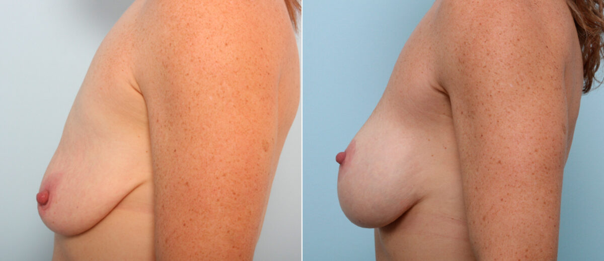 Breast Lift with Augmentation before and after photos in Houston, TX, Patient 57696