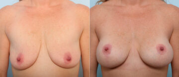 Breast Lift with Augmentation before and after photos in Houston, TX, Patient 57696