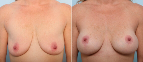 Breast Lift with Augmentation before and after photos in Houston, TX, Patient 57696