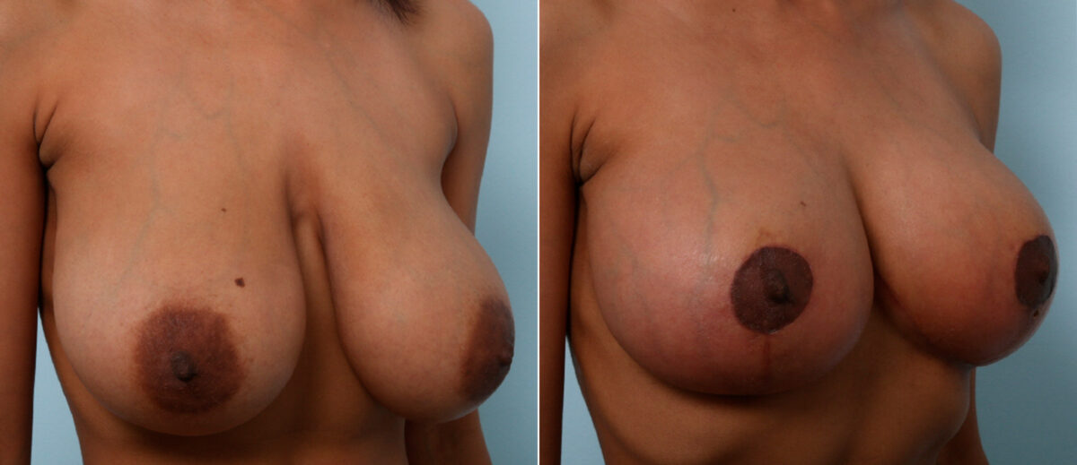 Breast Lift before and after photos in Houston, TX, Patient 57722