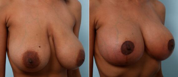 Breast Lift before and after photos in Houston, TX, Patient 57722