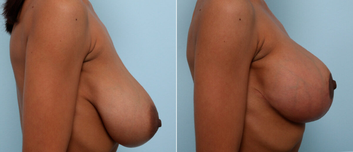 Breast Lift before and after photos in Houston, TX, Patient 57722