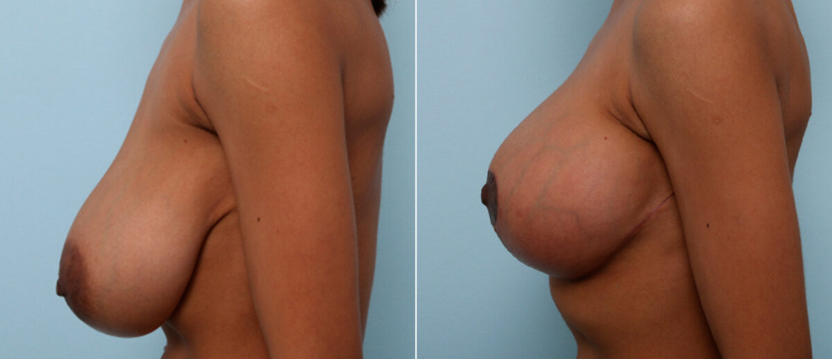 Breast Lift before and after photos in Houston, TX, Patient 57722