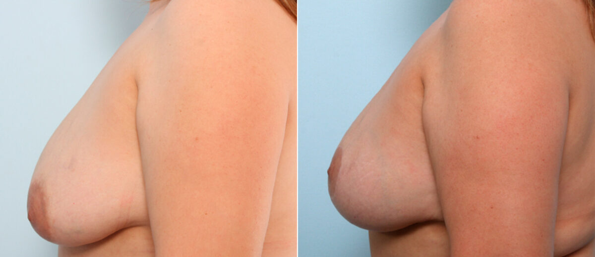 Breast Lift before and after photos in Houston, TX, Patient 57754