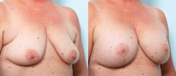 Breast Lift with Augmentation before and after photos in Houston, TX, Patient 57770