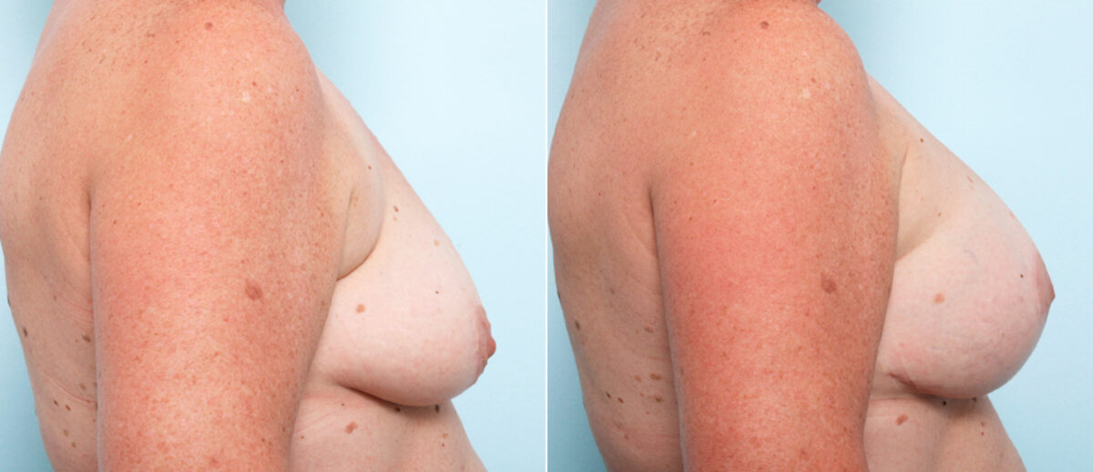 Breast Lift with Augmentation before and after photos in Houston, TX, Patient 57770