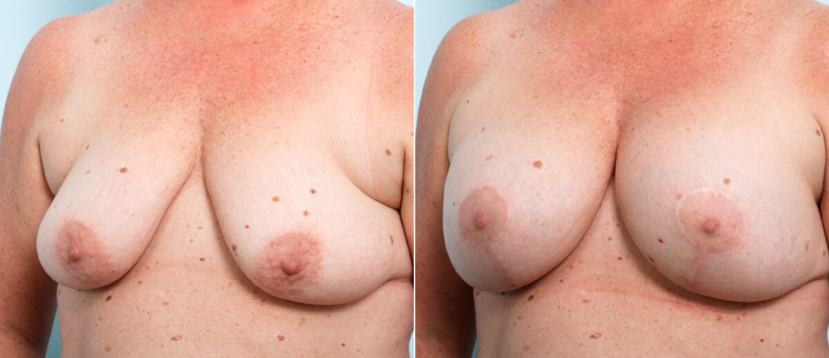 Breast Lift with Augmentation before and after photos in Houston, TX, Patient 57770