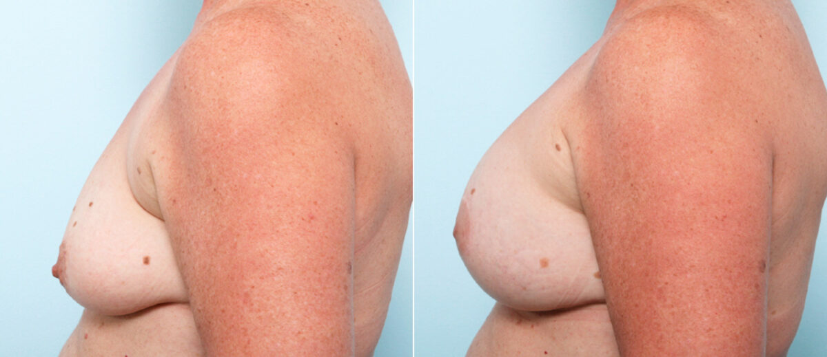 Breast Lift with Augmentation before and after photos in Houston, TX, Patient 57770