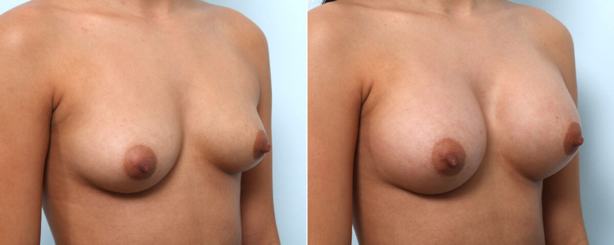 Breast Augmentation before and after photos in Houston, TX, Patient 58899