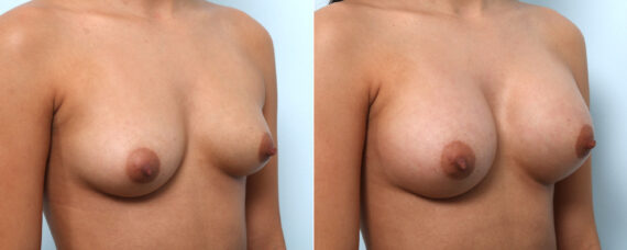 Breast Augmentation before and after photos in Houston, TX, Patient 58899