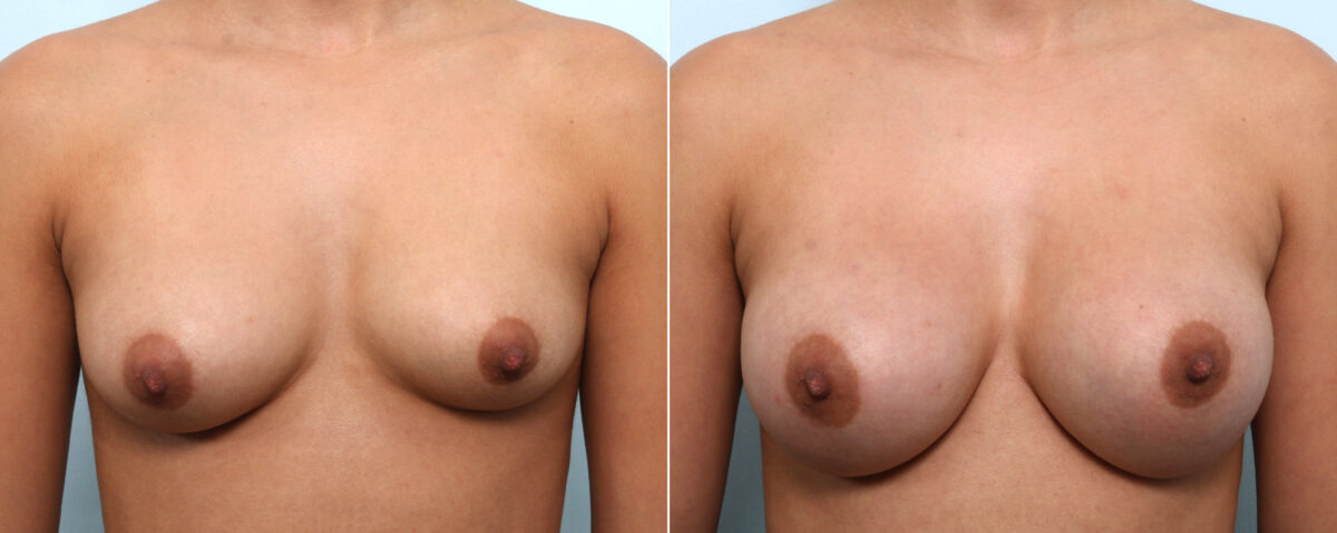 Breast Augmentation before and after photos in Houston, TX, Patient 58899