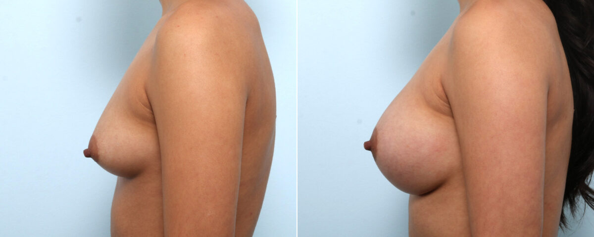 Breast Augmentation before and after photos in Houston, TX, Patient 58899