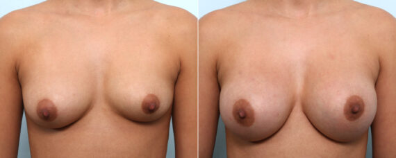 Breast Augmentation before and after photos in Houston, TX, Patient 58899