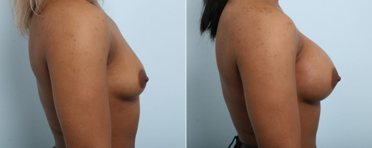 Breast Augmentation before and after photos in Houston, TX, Patient 59087