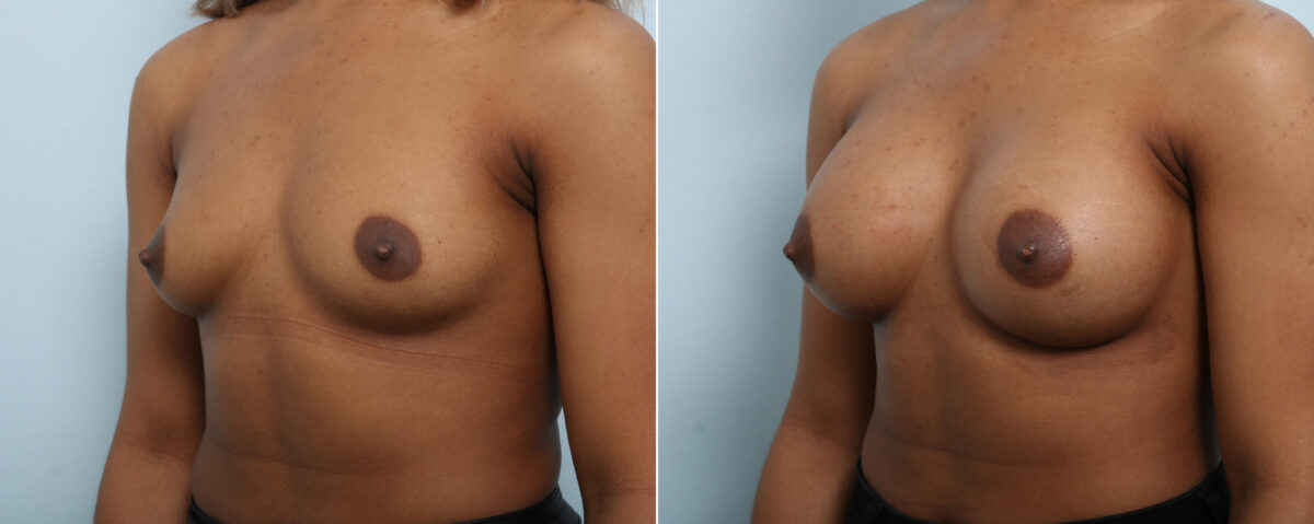 Breast Augmentation before and after photos in Houston, TX, Patient 59087