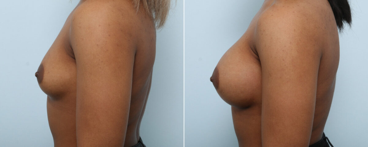 Breast Augmentation before and after photos in Houston, TX, Patient 59087