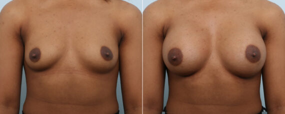 Breast Augmentation before and after photos in Houston, TX, Patient 59087
