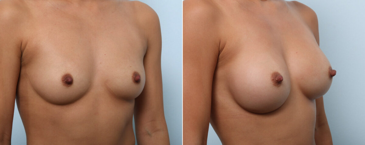 Breast Augmentation before and after photos in Houston, TX, Patient 59103