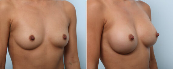 Breast Augmentation before and after photos in Houston, TX, Patient 59103