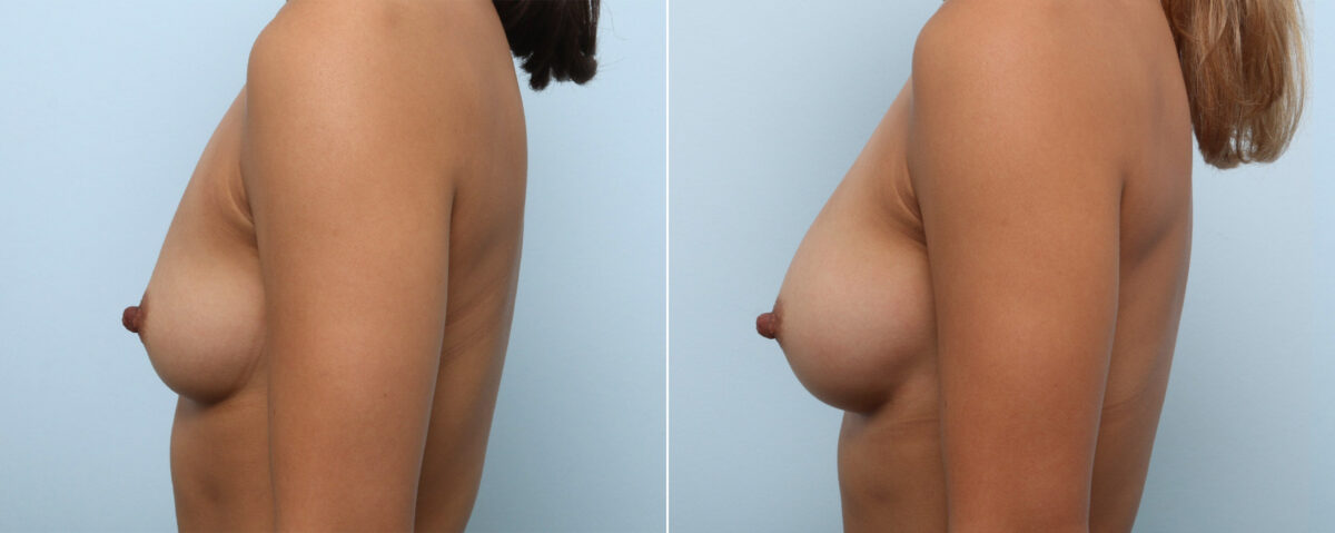 Breast Augmentation before and after photos in Houston, TX, Patient 59103
