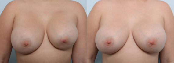 Breast Revision with Strattice before and after photos in Houston, TX