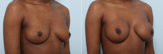 Breast Augmentation before and after photos in Houston, TX, Patient 59459