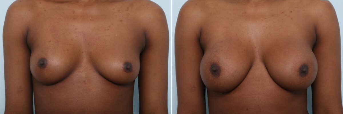 Breast Augmentation before and after photos in Houston, TX, Patient 59459