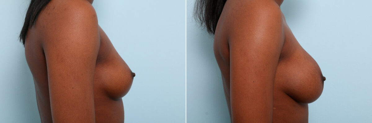 Breast Augmentation before and after photos in Houston, TX, Patient 59459