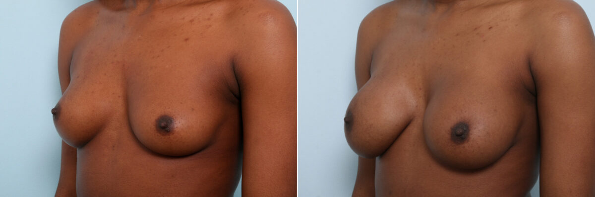 Breast Augmentation before and after photos in Houston, TX, Patient 59459