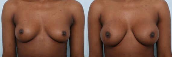 Breast Augmentation before and after photos in Houston, TX, Patient 59459