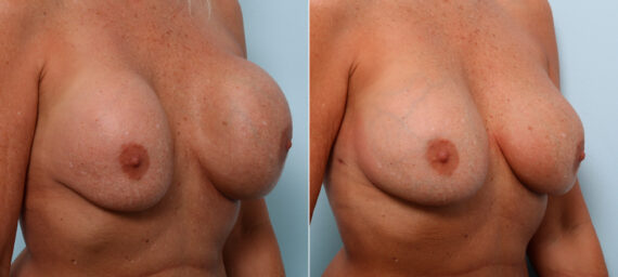 Breast Revision with Strattice before and after photos in Houston, TX, Patient 60075
