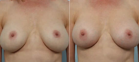 Breast Implant Exchange before and after photos in Houston, TX, Patient 70621