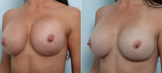 Breast Revision with Strattice before and after photos in Houston, TX, Patient 70648