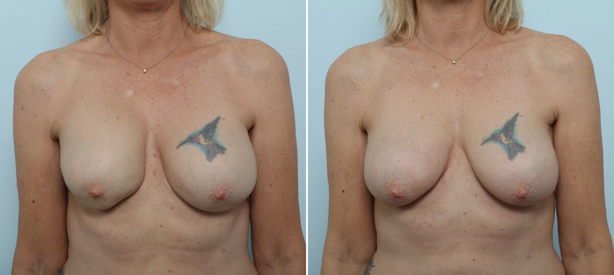 Breast Implant Removal before and after photos in Houston, TX, Patient 79314