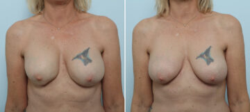 Breast Implant Removal before and after photos in Houston, TX, Patient 79314