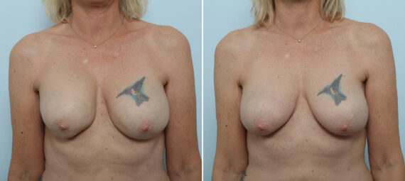 Breast Implant Removal before and after photos in Houston, TX, Patient 79314