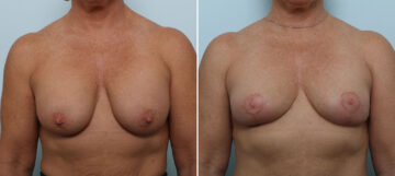Breast Implant Removal before and after photos in Houston, TX, Patient 79316