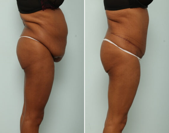 Tummy Tuck/Abdominoplasty before and after photos in Houston, TX, Patient 85407
