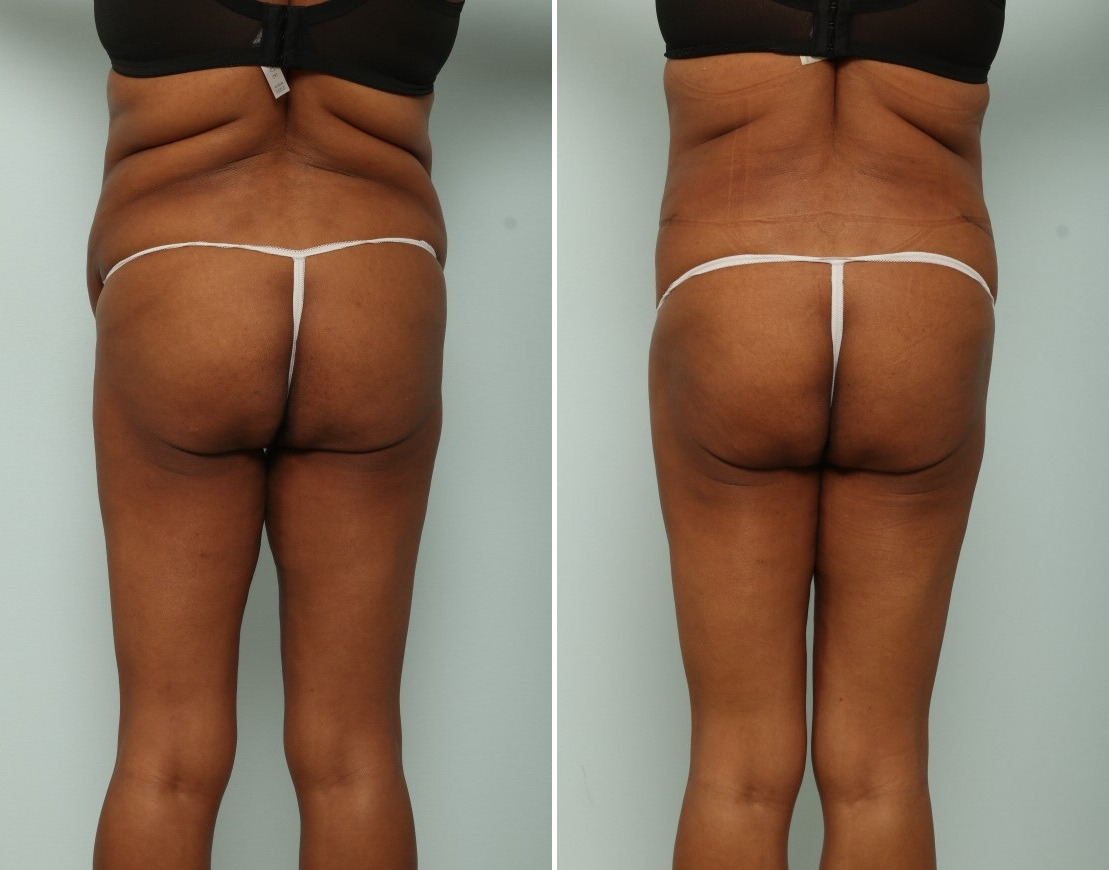 Tummy Tuck/Abdominoplasty before and after photos in Houston, TX, Patient 85407