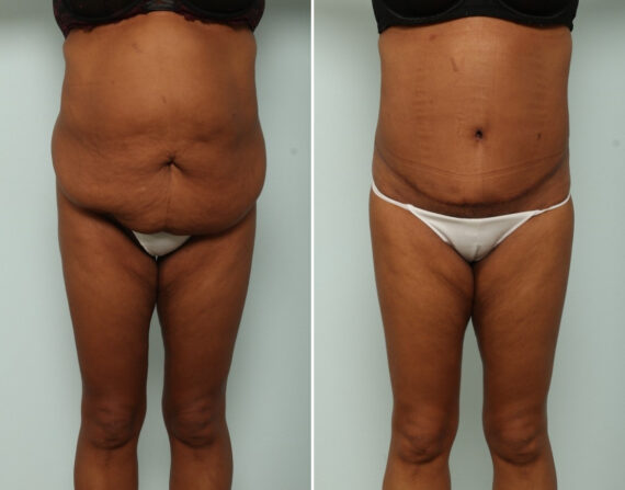 Tummy Tuck/Abdominoplasty before and after photos in Houston, TX, Patient 85407