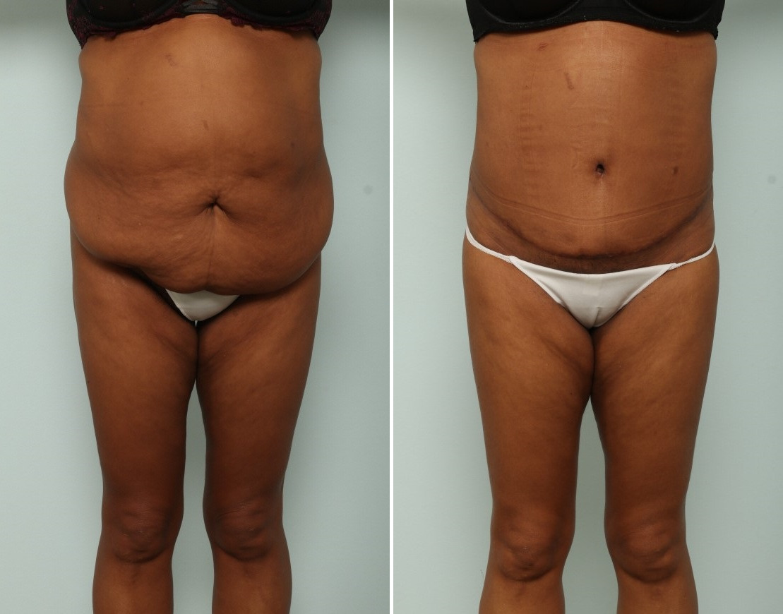 Tummy Tuck/Abdominoplasty before and after photos in Houston, TX, Patient 85407