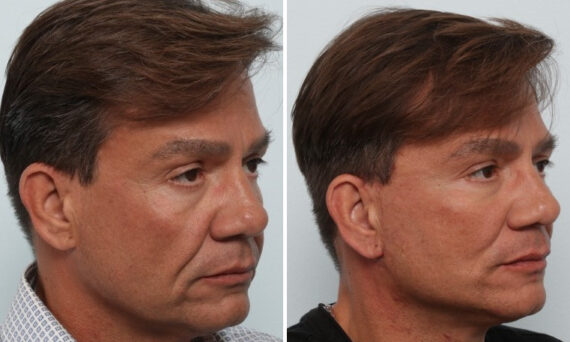 Facelift before and after photos in Houston, TX, Patient 85474