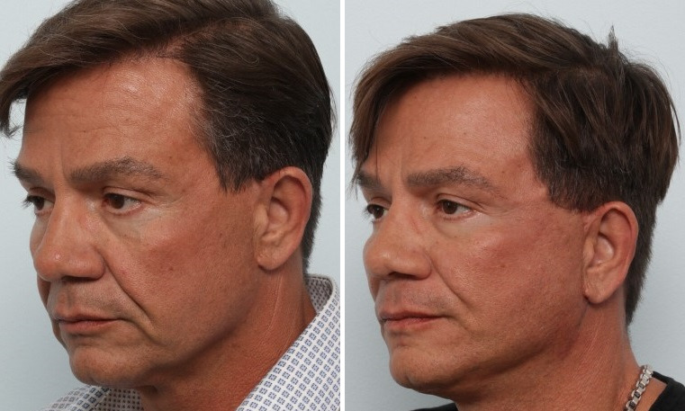 Facelift before and after photos in Houston, TX, Patient 85474