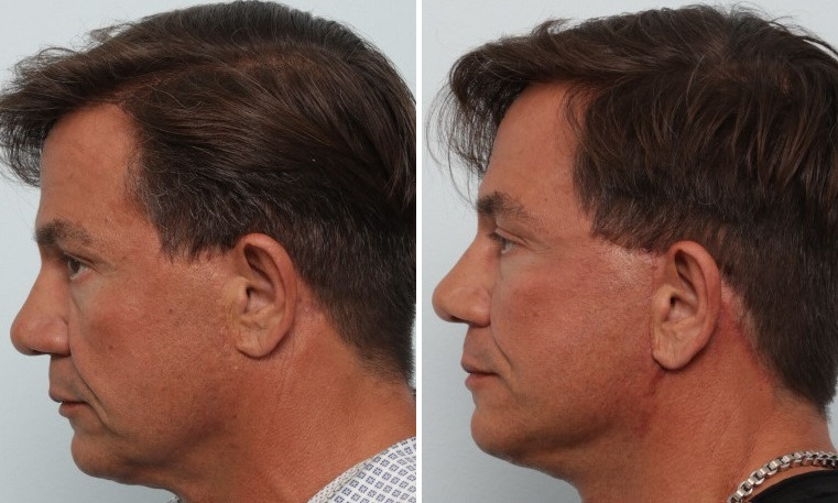Facelift before and after photos in Houston, TX, Patient 85474