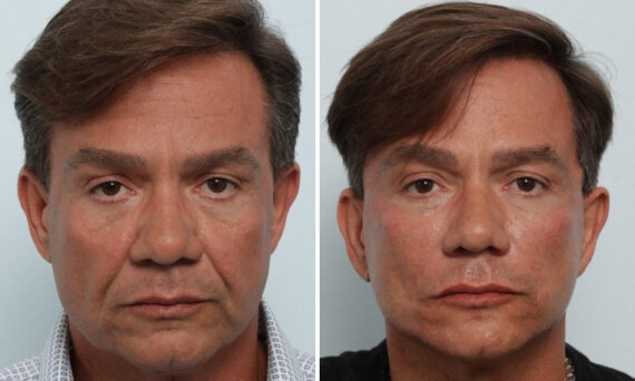 Facelift before and after photos in Houston, TX, Patient 85474