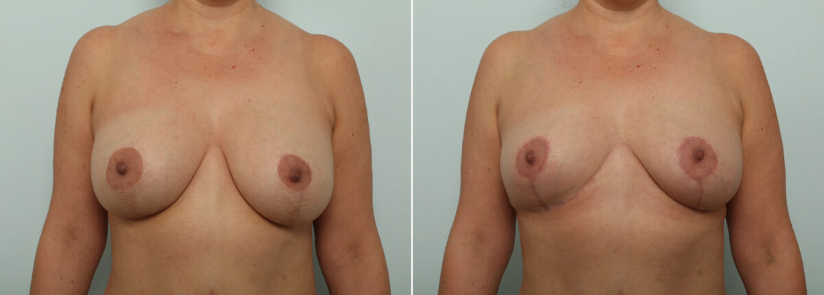 Patient 85568, Breast Implant Removal before and after photos Breast Implant Removal before and after photos in Houston, TX, Patient 85568