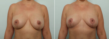 Breast Implant Removal before and after photos in Houston, TX, Patient 85568