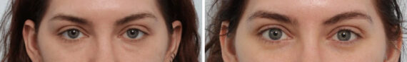 Blepharoplasty before and after photos in Houston, TX, Patient 85690