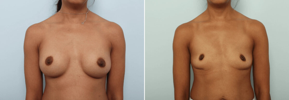 Breast Implant Removal before and after photos in Houston, TX, Patient 85691