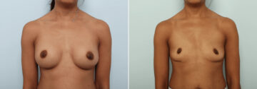 Breast Implant Removal before and after photos in Houston, TX, Patient 85691